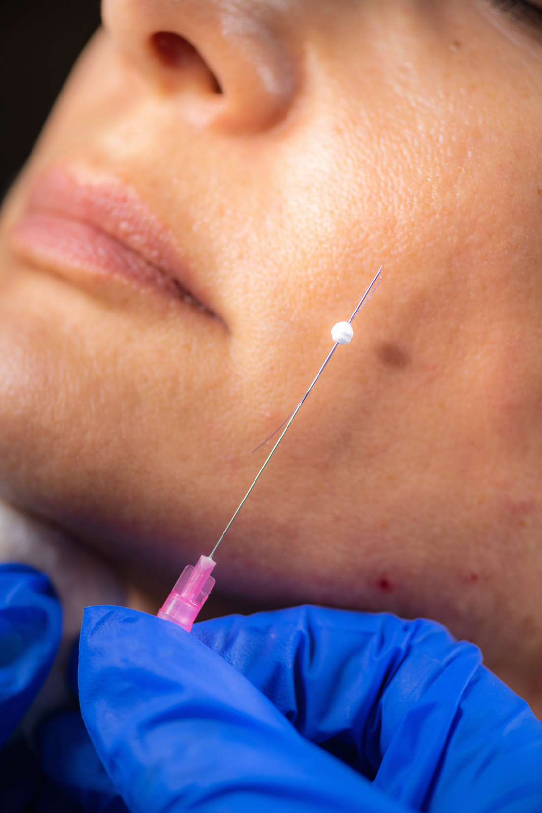 Aesthetic Medicine Facial Contouring with 3D Meso Threads.